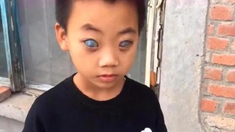 黑龙江8岁男孩天生“鬼眼”，出生四个月被父亲抛弃！太可怜了
