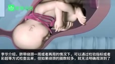脐带绕颈六周“奇迹宝宝”顺产出世 医生：工作23年第一次见