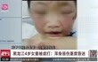 黑龙江4岁女童被虐打:浑身是伤重度昏迷